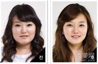 整容视频实拍,实拍视频带你直击美丽蜕变